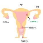 50歳前後に多い子宮体がん
